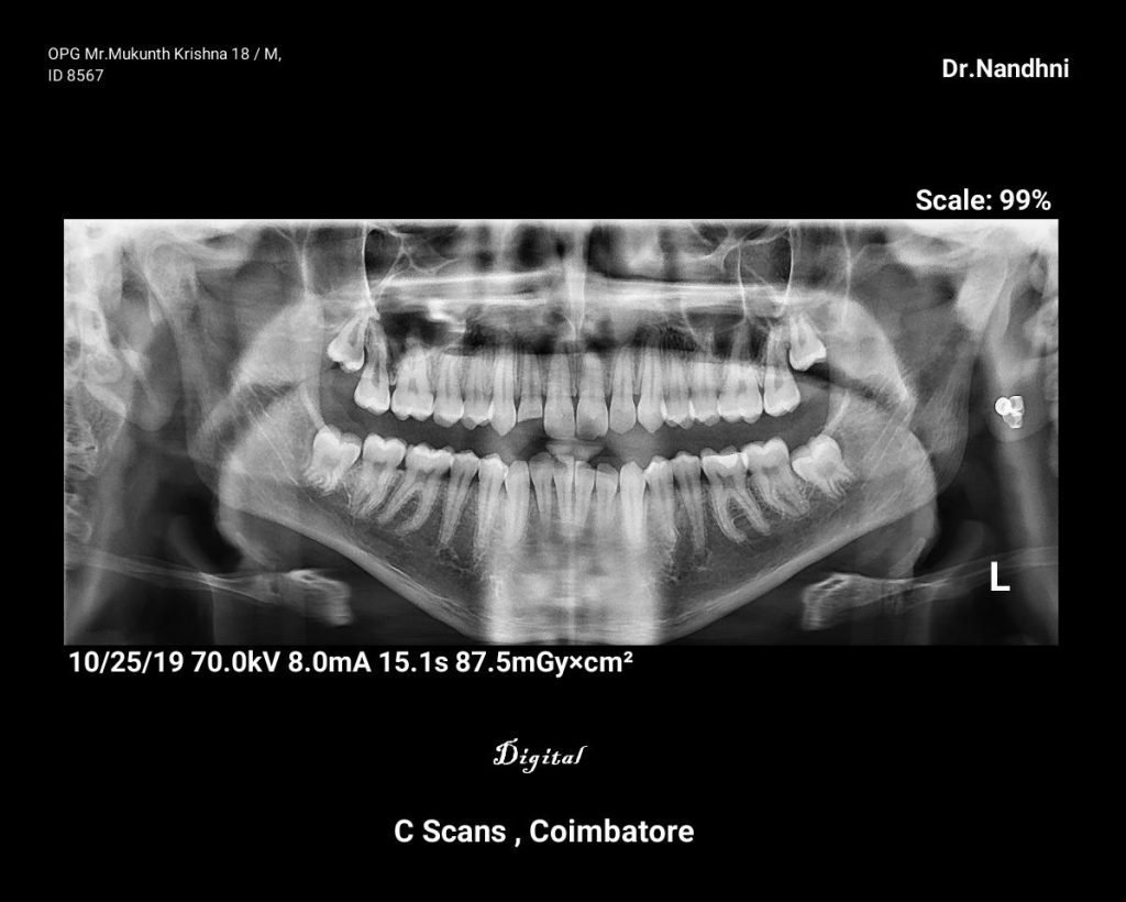 Digital X-Ray