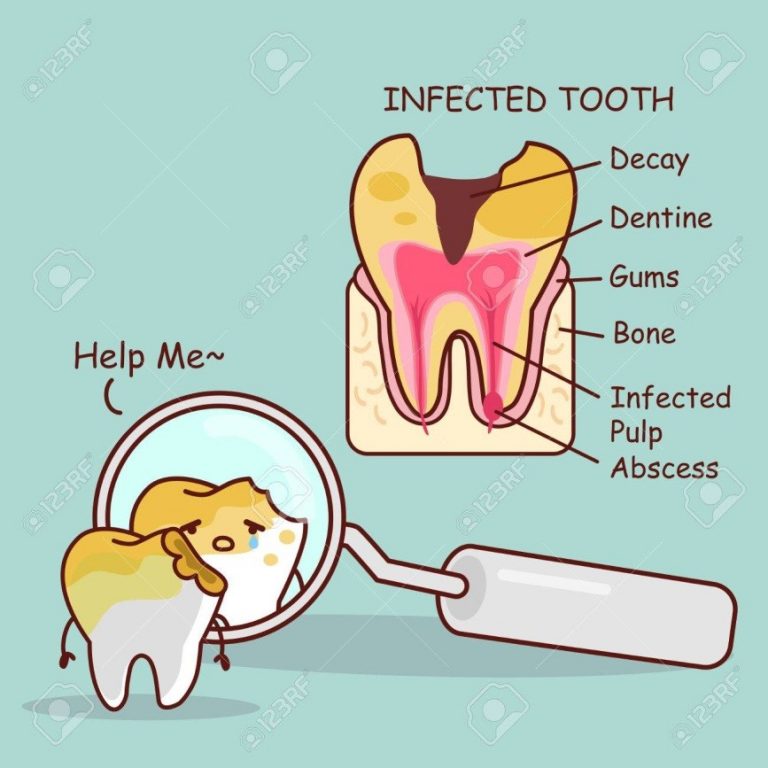 Root Canal The Dentist Coimbatore