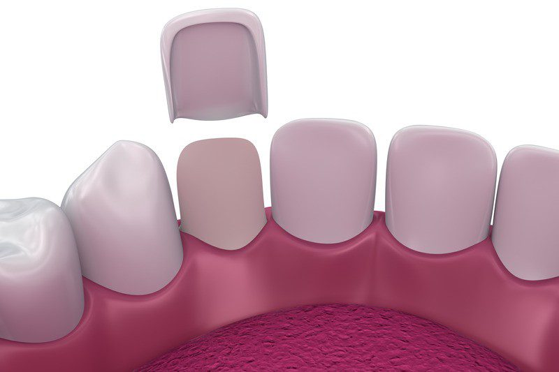 Dental Veneers