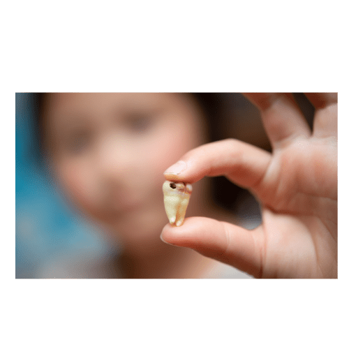 Tooth Decay and Cavity Treatment