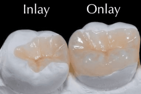 Inlays and Onlays