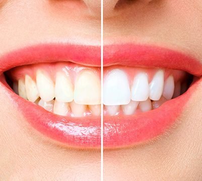 whitening-1.jpg